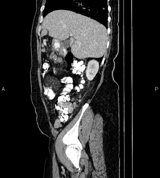 Abdominal lymphoma with sandwich sign (Radiopaedia 84378-99704 Sagittal C+ portal venous phase 16).jpg