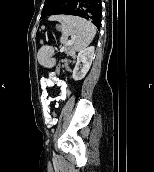 Abdominal lymphoma with sandwich sign (Radiopaedia 84378-99704 Sagittal C+ portal venous phase 70).jpg