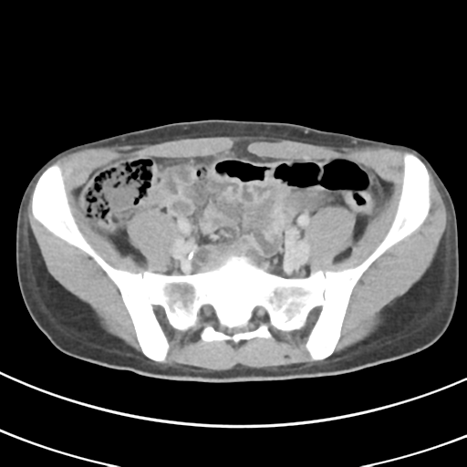 File:Abdominal multi-trauma - devascularised kidney and liver, spleen and pancreatic lacerations (Radiopaedia 34984-36486 Axial C+ delayed 59).png