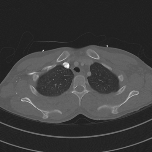 File:Abdominal multi-trauma - devascularised kidney and liver, spleen and pancreatic lacerations (Radiopaedia 34984-36486 I 19).png