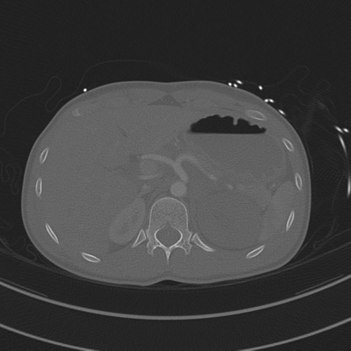 File:Abdominal multi-trauma - devascularised kidney and liver, spleen and pancreatic lacerations (Radiopaedia 34984-36486 I 92).png