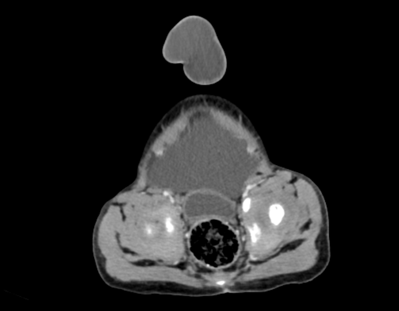 Abdominal premesenteric cystic lymphangioma (Radiopaedia 82995-97350 Axial C+ portal venous phase 61).jpg