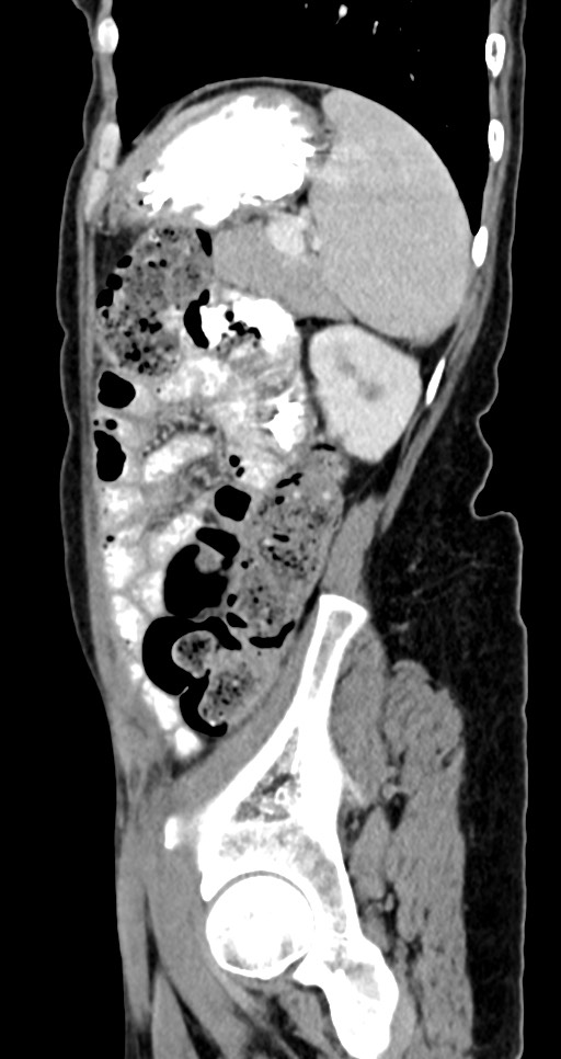 Abdominal wall and retroperitoneal tuberculosis (Radiopaedia 88137-104729 Sagittal C+ portal venous phase 39).jpg