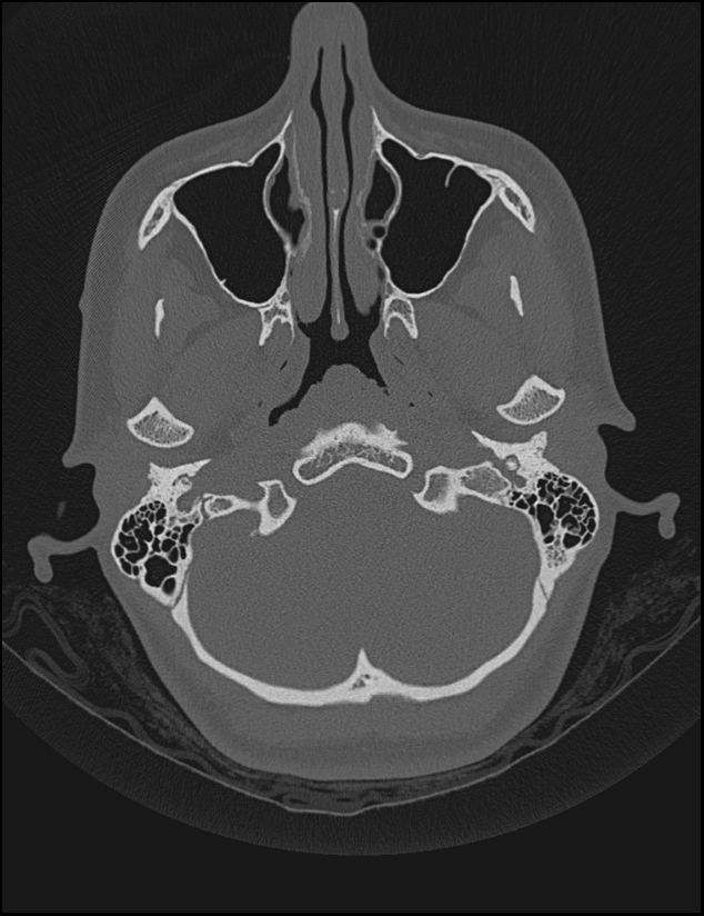 Aberrant right internal carotid artery (Radiopaedia 65191-74198 Axial non-contrast 21).jpg
