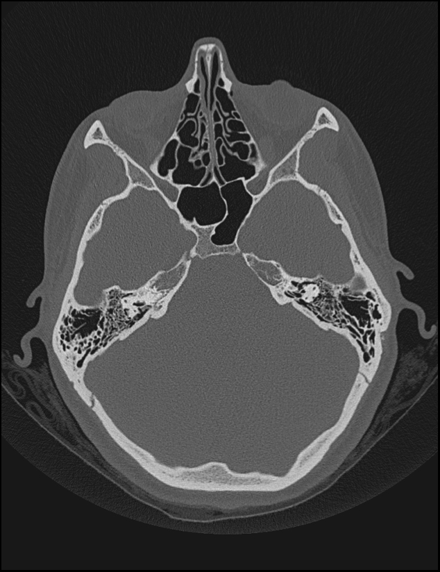 Aberrant right internal carotid artery (Radiopaedia 65191-74198 Axial non-contrast 54).jpg