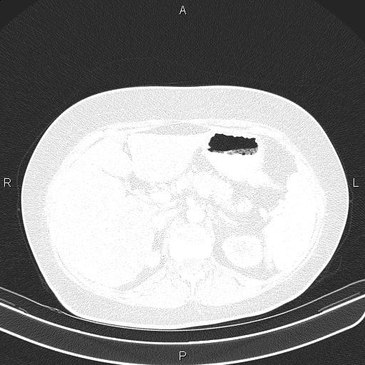 Aberrant right subclavian artery (Radiopaedia 87334-103629 Axial lung window 72).jpg