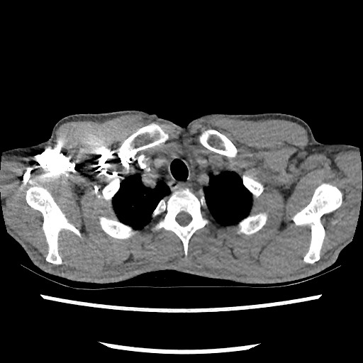 Accessory left horizontal fissure with lingular pneumonia (Radiopaedia 53763-59843 Axial C+ CTPA 12).jpg
