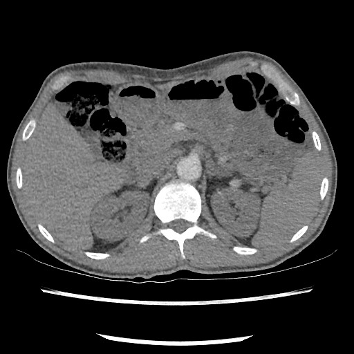 Accessory left horizontal fissure with lingular pneumonia (Radiopaedia 53763-59843 Axial C+ CTPA 96).jpg