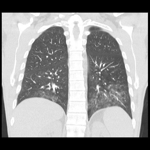 Accessory left horizontal fissure with lingular pneumonia (Radiopaedia 53763-59843 Coronal lung window 33).jpg