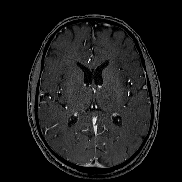 Accessory middle cerebral artery (Radiopaedia 73114-83828 Axial MRA 115).jpg