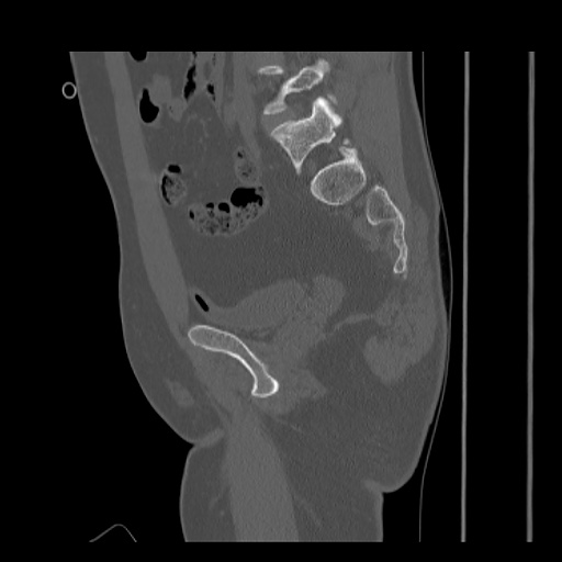 Acetabular and ilial fractures (Radiopaedia 59084-66378 Sagittal bone window 44).jpg