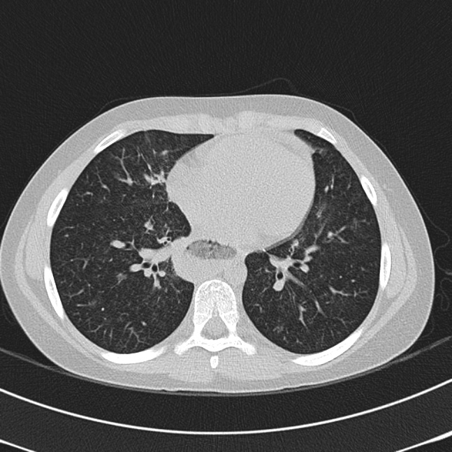 Achalasia (Radiopaedia 14946-14878 Axial lung window 48).jpg