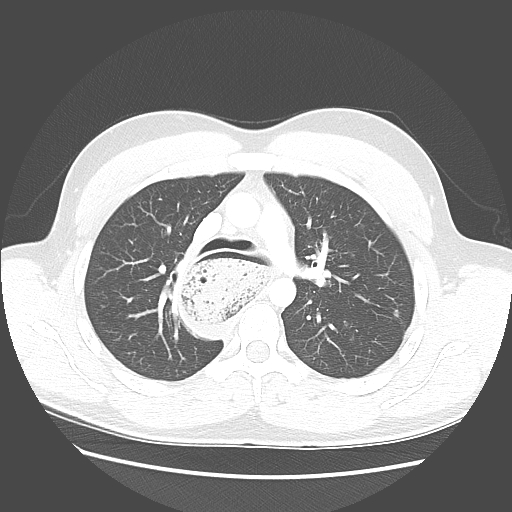 Achalasia (Radiopaedia 52507-58417 Axial lung window 23).jpg