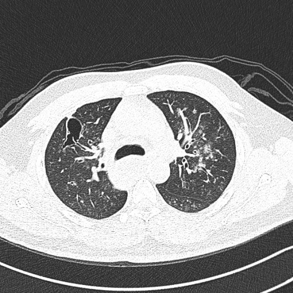 Achalasia with aspiration (Radiopaedia 55413-61845 Axial lung window 24).jpg