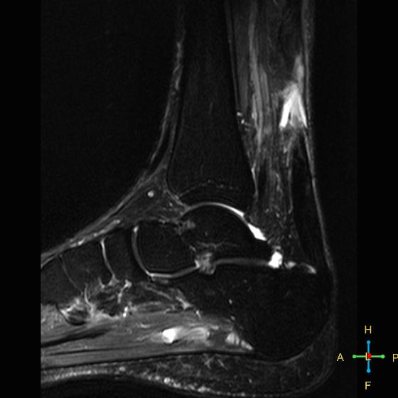 File:Achilles tendon complete tear (Radiopaedia 22834-22854 Sagittal STIR 10).jpg