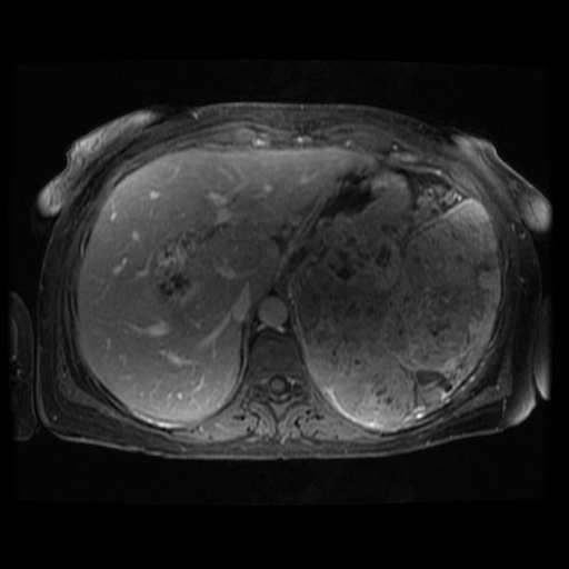 Acinar cell carcinoma of the pancreas (Radiopaedia 75442-86668 Axial T1 C+ fat sat 101).jpg