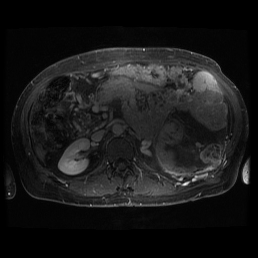 Acinar cell carcinoma of the pancreas (Radiopaedia 75442-86668 Axial T1 C+ fat sat 47).jpg