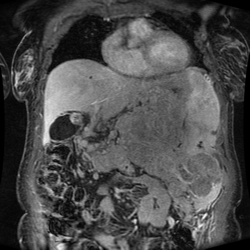File:Acinar cell carcinoma of the pancreas (Radiopaedia 75442-86668 Coronal T1 C+ fat sat 129).jpg