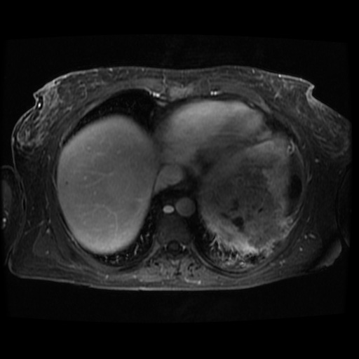 Acinar cell carcinoma of the pancreas (Radiopaedia 75442-86668 D 131).jpg