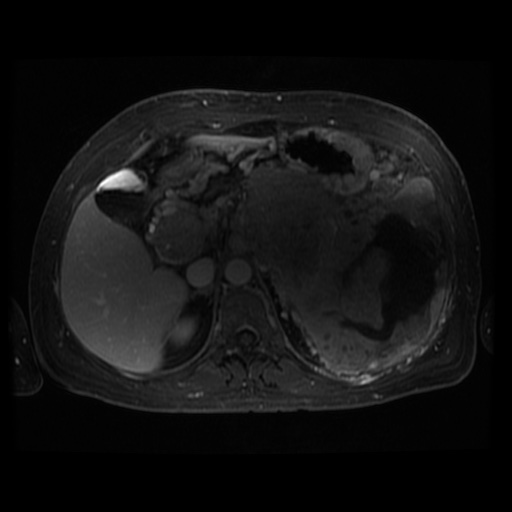 Acinar cell carcinoma of the pancreas (Radiopaedia 75442-86668 D 76).jpg