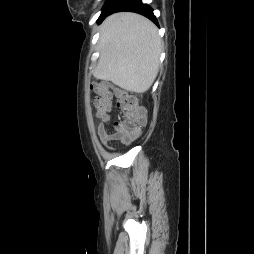 Acinar cell carcinoma of the pancreas (Radiopaedia 75442-86669 Sagittal C+ portal venous phase 41).jpg