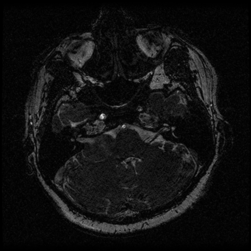 Acoustic schwannoma (Radiopaedia 33045-34060 Axial T2 24).png