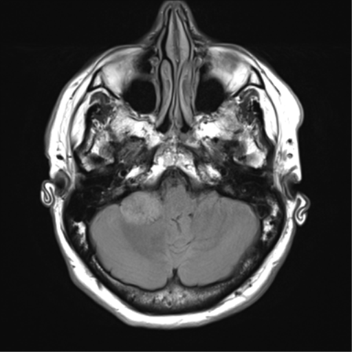 File:Acoustic schwannoma (Radiopaedia 50846-56358 Axial FLAIR 7).png