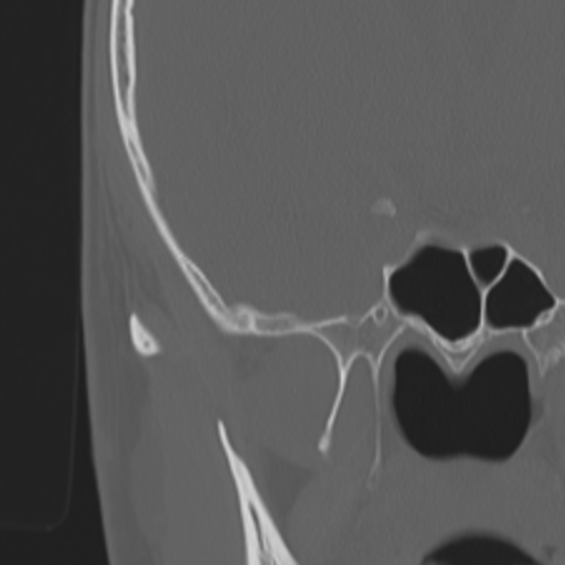 Acoustic schwannoma - eroding petrous apex (Radiopaedia 39674-42002 Coronal bone window 28).png