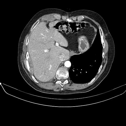 File:Acquired adrenal hyperplasia - due to thymic carcinoid tumor (Radiopaedia 21269-21184 C+ arterial phase 7).jpg