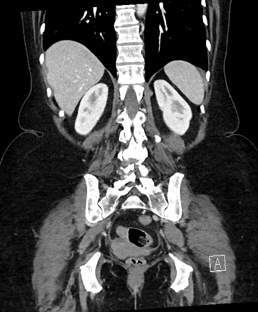 Active Crohn disease (Radiopaedia 59394-66750 Coronal C+ portal venous phase 52).jpg