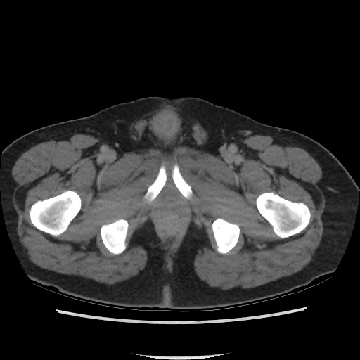 File:Active colonic bleed on CT (Radiopaedia 49765-55025 Axial C+ delayed 87).jpg