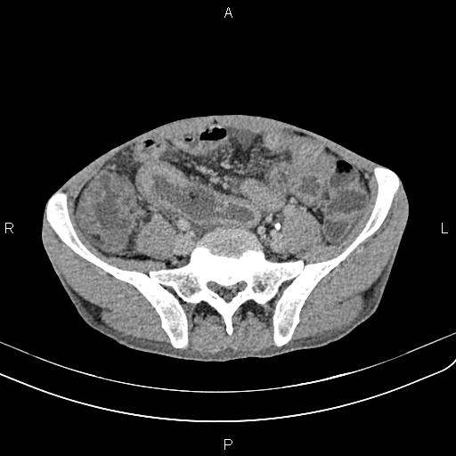 Active crohn disease (Radiopaedia 87133-103397 Axial C+ delayed 50).jpg