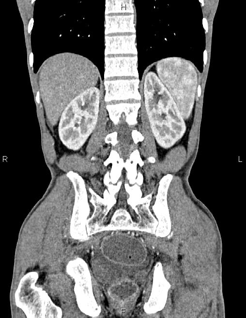 Active crohn disease (Radiopaedia 87133-103397 Coronal C+ arterial phase 49).jpg