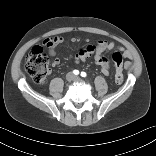 File:Active diverticular hemorrhage (Radiopaedia 39415-41725 Axial C+ arterial phase 43).png
