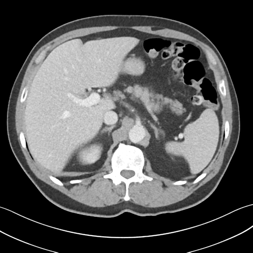 File:Active diverticular hemorrhage (Radiopaedia 39415-41725 Axial C+ portal venous phase 16).png