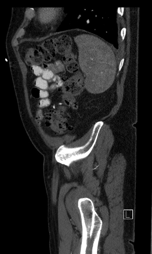 Active lower gastrointestinal bleeding - diverticular (Radiopaedia 61203-69106 Sagittal C+ arterial phase 25).jpg