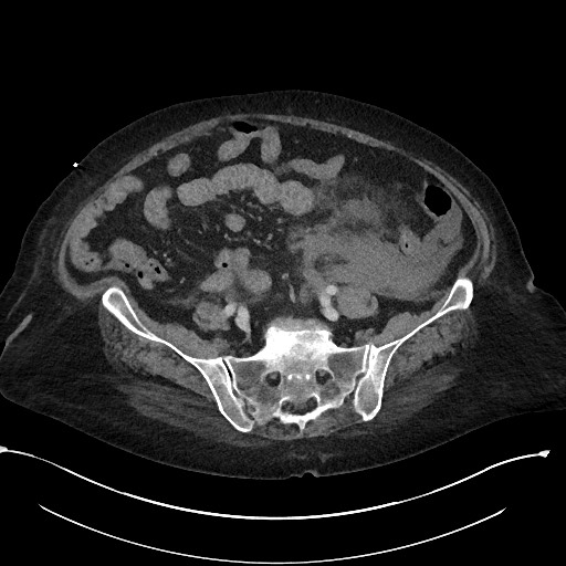 File:Active renal extravasation with large subcapsular and retroperitoneal hemorrhage (Radiopaedia 60975-68796 Axial 256).jpg