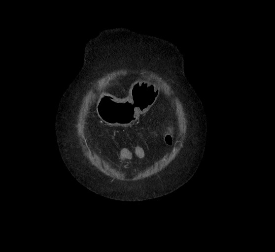 Active renal extravasation with large subcapsular and retroperitoneal hemorrhage (Radiopaedia 60975-68796 Coronal C+ arterial phase 21).jpg