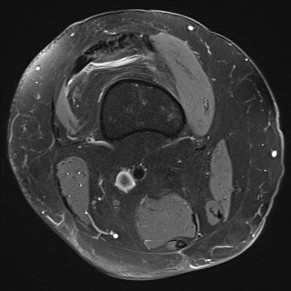 File:Acute-on-chronic transient lateral patellar dislocation with trochlear dysplasia (Radiopaedia 84099-99349 Axial PD fat sat 3).jpg