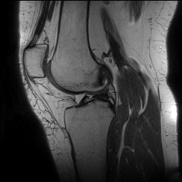 Acute-on-chronic transient lateral patellar dislocation with trochlear dysplasia (Radiopaedia 84099-99349 Sagittal PD 89).jpg