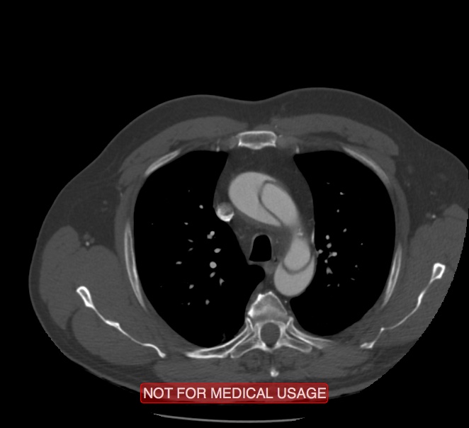 Acute aortic dissection - Stanford type A (Radiopaedia 40661-43285 Axial C+ arterial phase 10).jpg