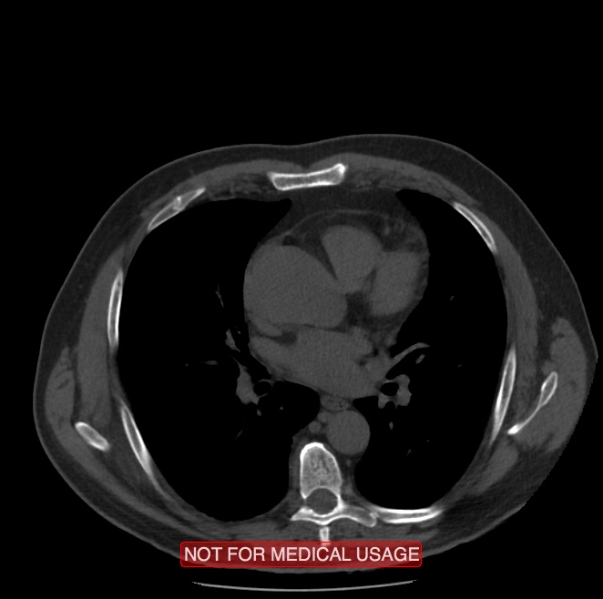 Acute aortic dissection - Stanford type A (Radiopaedia 40661-43285 Axial non-contrast 31).jpg