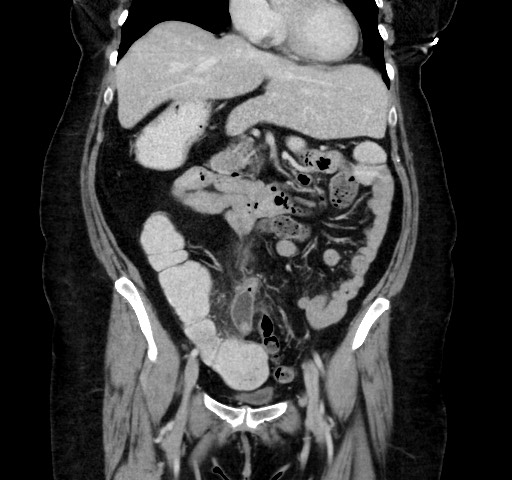 Acute appendicitis, heterotaxy syndrome (Radiopaedia 66884-76202 Coronal C+ portal venous phase 52).jpg