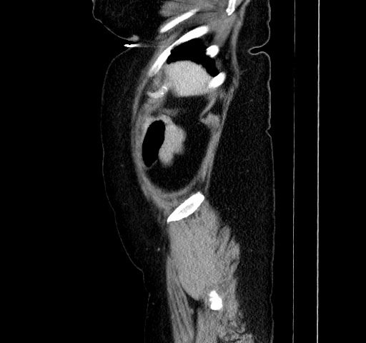 Acute appendicitis, heterotaxy syndrome (Radiopaedia 66884-76202 Sagittal C+ portal venous phase 115).jpg