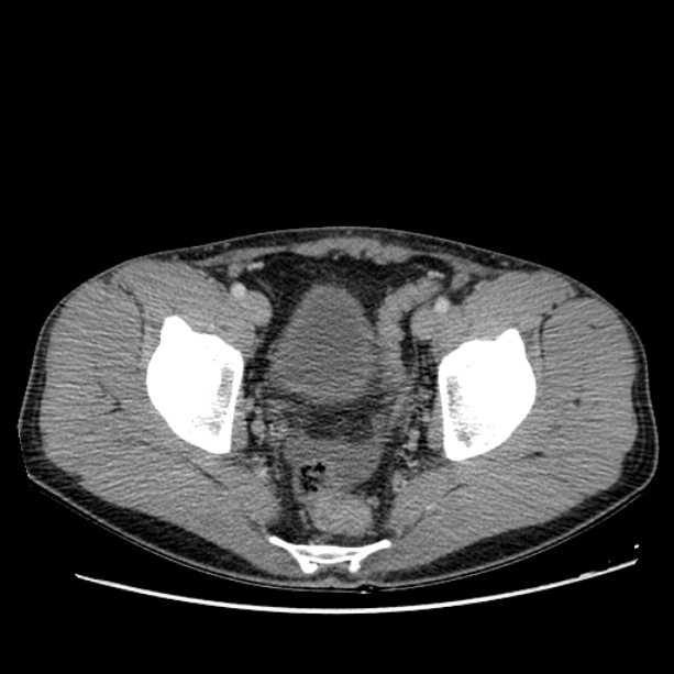 Acute appendicitis (Radiopaedia 27049-27227 Axial C+ portal venous phase 68).jpg