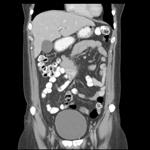File:Acute appendicitis (Radiopaedia 30297-30934 Coronal C+ portal venous phase 15).jpg