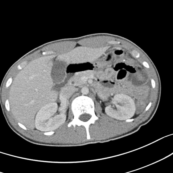 Acute appendicitis (Radiopaedia 32614-33572 Axial C+ portal venous phase 20).jpg