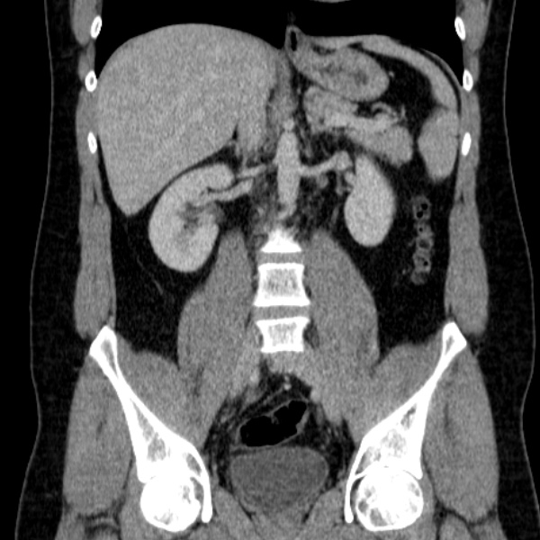 Acute appendicitis (Radiopaedia 38255-40270 Coronal C+ portal venous phase 49).jpg