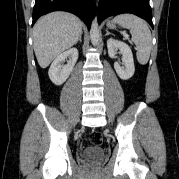 Acute appendicitis (Radiopaedia 38255-40270 Coronal C+ portal venous phase 55).jpg