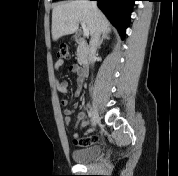 Acute appendicitis (Radiopaedia 38255-40270 Sagittal C+ portal venous phase 35).jpg